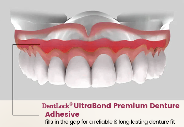 DentLock® UltraBond Premium Denture Adhesive 🔥 FDA Certified (Clinically Proven 4-Day Hold for Secure, Comfortable & Zinc-Free Denture Fit 🦷)