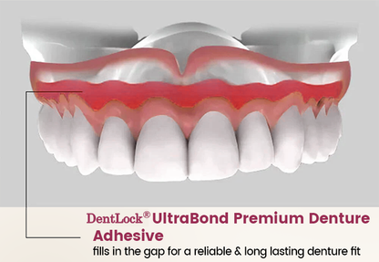 DentLock® UltraBond Premium Denture Adhesive 🔥 FDA Certified (Clinically Proven 4-Day Hold for Secure, Comfortable & Zinc-Free Denture Fit 🦷)