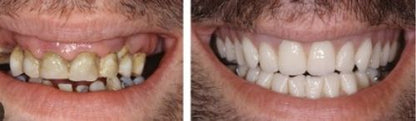 DentLock® UltraBond Premium Denture Adhesive 🔥 FDA Certified (Clinically Proven 4-Day Hold for Secure, Comfortable & Zinc-Free Denture Fit 🦷)