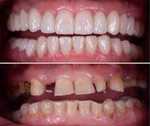 DentLock® UltraBond Premium Denture Adhesive 🔥 FDA Certified (Clinically Proven 4-Day Hold for Secure, Comfortable & Zinc-Free Denture Fit 🦷)