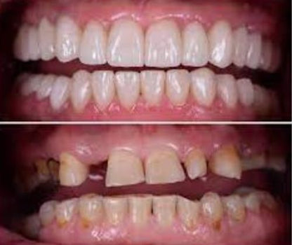 DentLock® UltraBond Premium Denture Adhesive 🔥 FDA Certified (Clinically Proven 4-Day Hold for Secure, Comfortable & Zinc-Free Denture Fit 🦷)